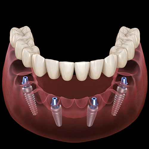 All-on-4 Dental Implants